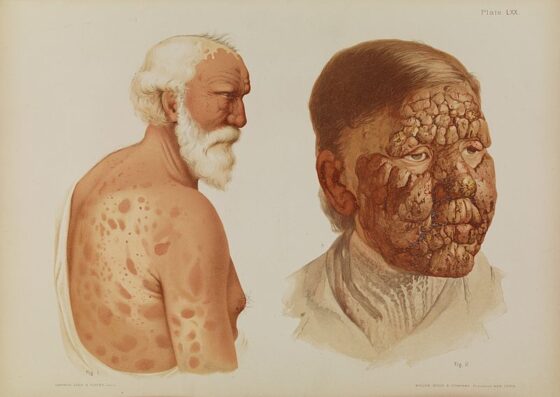 Everything You Need to Know About Leprosy