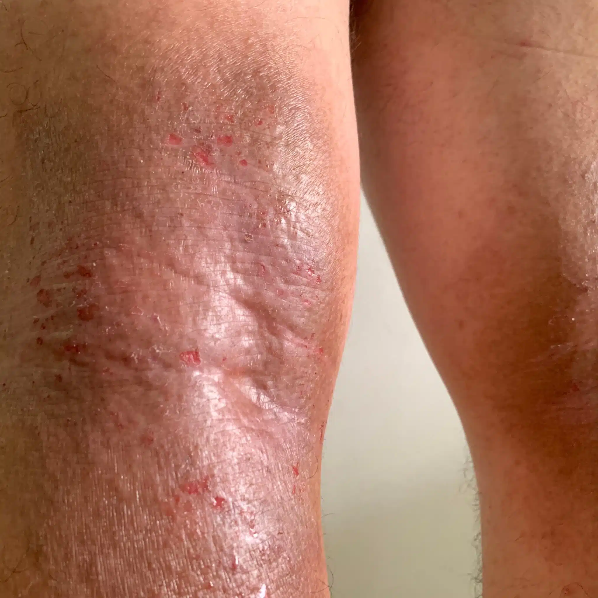 Eczema