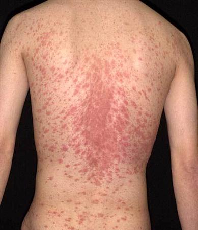 Pityriasis Rosea