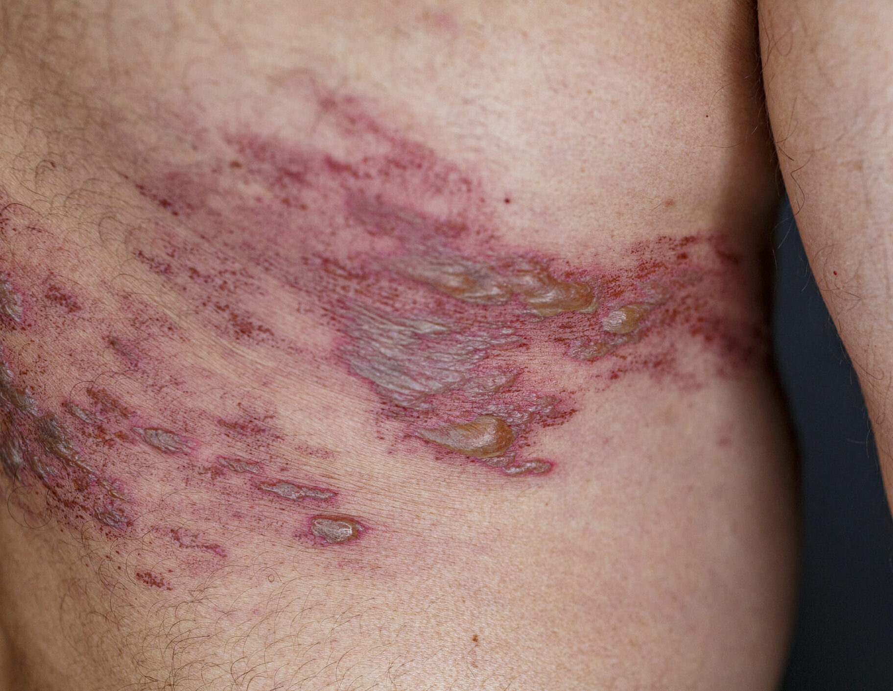 Herpes Zoster
