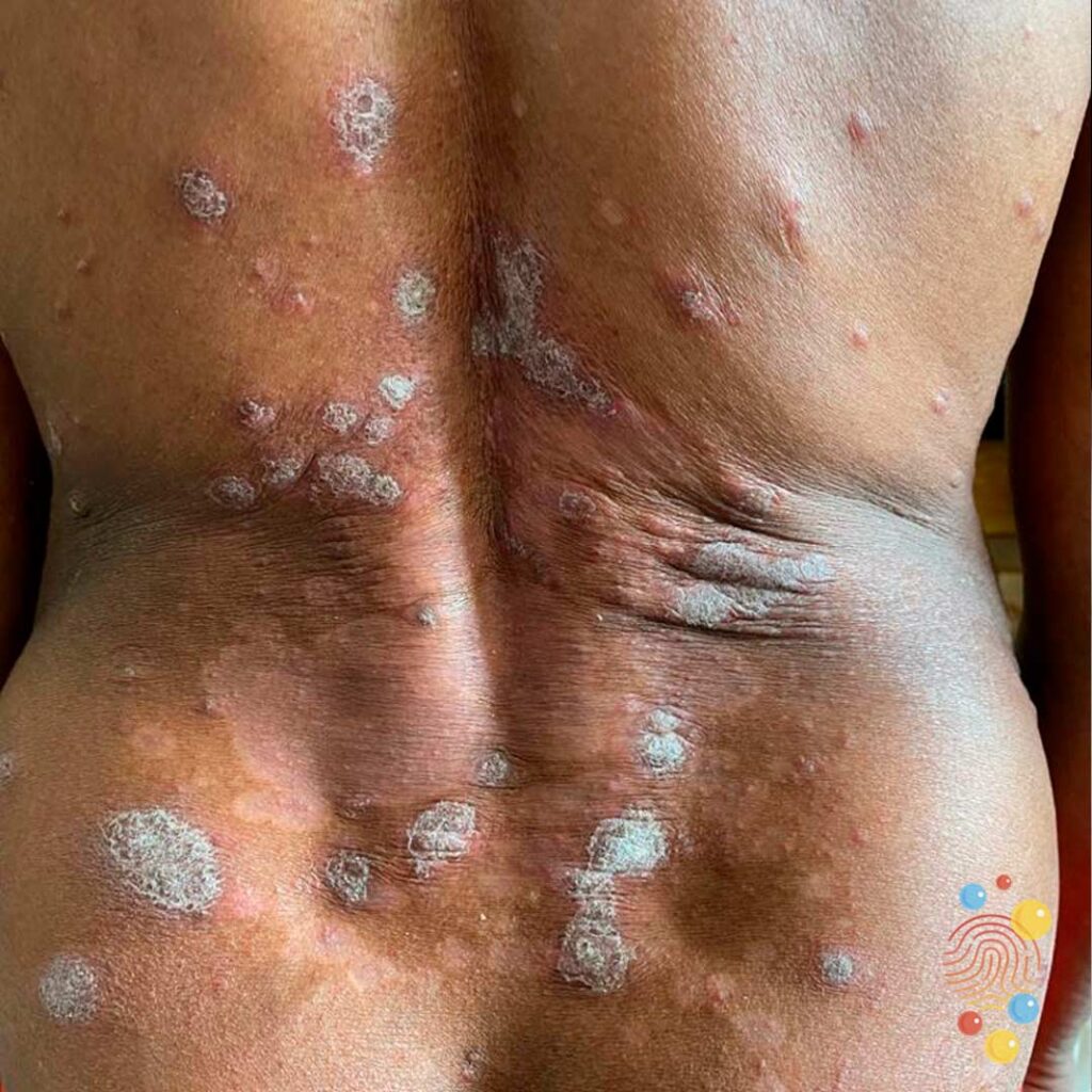 Psoriasis
